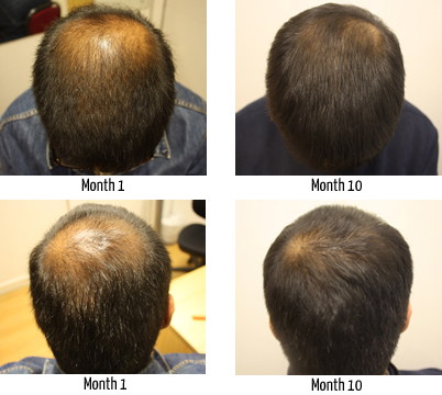 hair regrow frontal hairline